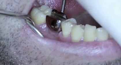 Video: Rugby players receive tooth implant that doubles as a bottle opener