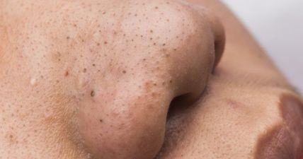 This DIY life hack makes getting rid of blackheads devastatingly simple