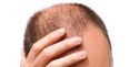 Men should avoid this one particular hairstyle because it makes you go bald…