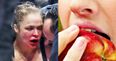 Ronda Rousey: My jaw is so f*cked I can’t even eat an apple