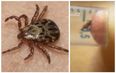 Watch how to stop a blood-sucking tick from burrowing into your leg