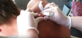 This guy’s 30-year-old cyst being popped is even more disgusting than you could ever imagine