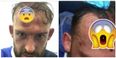 Steven Fletcher’s horrific head gash is not for the squeamish