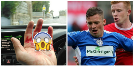 Irish striker suffers one of the most gruesome finger injuries we’ve ever seen