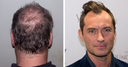 14 things a man goes through when he starts losing his hair