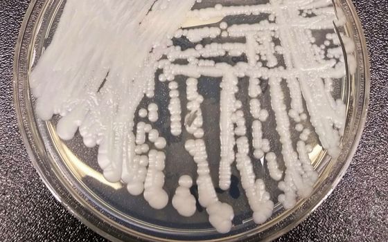 Dangerous drug-resistant fungus spreading in the US