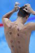 What are the dark circles on swimmers’ backs at Tokyo Olympics?