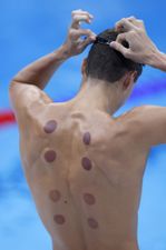 What are the dark circles on swimmers’ backs at Paris Olympics