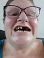 Desperate mum pulls out 11 of her own teeth because she couldn’t find a dentist