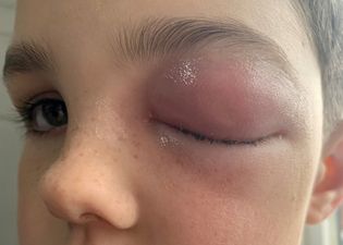 Boy, nine, ‘almost goes blind’ after suffering rare ‘Covid-eye’ side effect