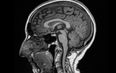 Covid brain can cause brain to shrink, new study finds