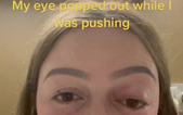 Woman pushed so hard while giving birth that her eye ‘popped out’