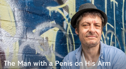 Dad reveals all about the moment his penis fell off – and how he replaced it with a bigger one