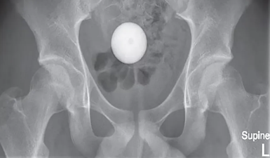 Boy, 14, has golf ball removed from his butt