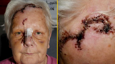 Pensioner given just £500 compensation after neighbour’s dog ripped her scalp down to the skull
