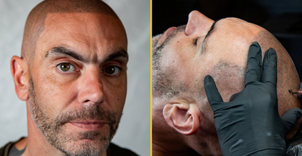 Bald man spends thousands to have hair tattooed on his head