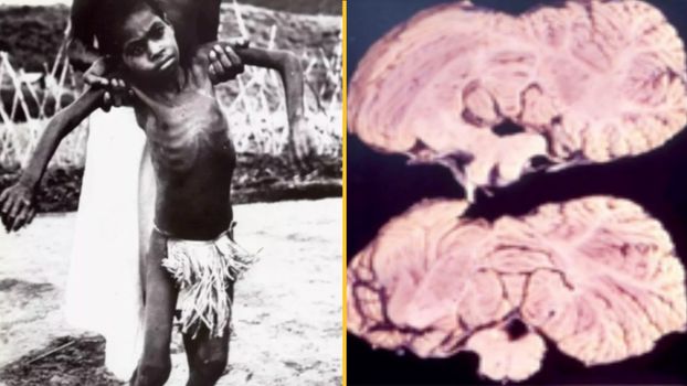 World's most deadly disease has fatality rate of almost 100%