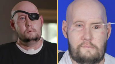 Man receives first-ever eye transplant after losing half his face in electrocution