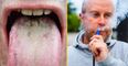 Dentist issues warning over ‘Vaper’s Tongue’ this Christmas