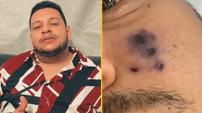 Singer dies from horror spider bite on his face