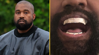 Kanye West’s £670,000 titanium dentures are ‘permanent’ and ‘go beyond veneers or grills’