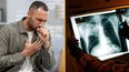 Warnings issued over rise of TB cases in the UK
