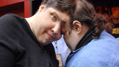 World’s oldest conjoined twins die after lifetime spent joined at the head