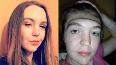 Woman warns against putting feet on dashboard after she lost entire forehead